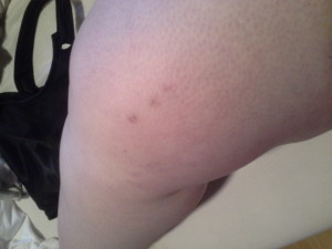 Cat paw lipedema bruise