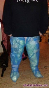 Calves Bagged Up after Tumescent Liposuction for Lipedema