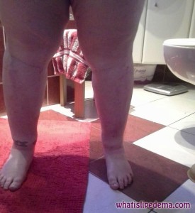 Calves 1 day after liposuction for lipedema