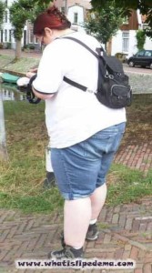 Petra's Legs Pre-Tumescent Liposuction for Lipedema