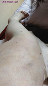 Left Thigh Bruises 1 Week Post Op