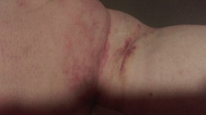 Blister/Rash on back of knee from bad fitting night compression garment