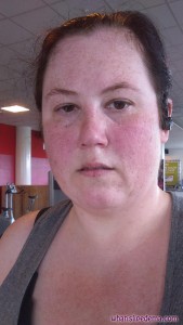 At the Gym Day 5 Post Op on Left Thigh