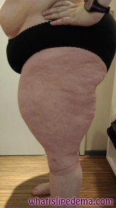 Left side of the thigh