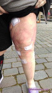 The day after liposuction on my left thigh