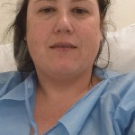 Recovery after tumescent liposuction on left thigh