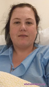 Recovery after tumescent liposuction on left thigh