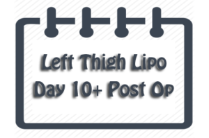 Left thigh lipo - day 10+ post op