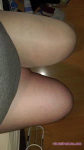week3-post-op-002