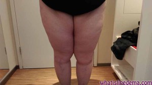 April-22-thighs-whatislipedema