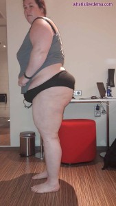 Butt before liposuction Aug 23 2016
