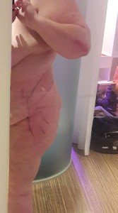 Day 1 Post Op After Butt Liposuction