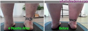 Calf Liposuction Before and After