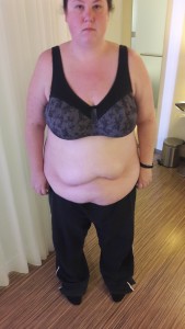 Pre-op full front photo