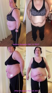 Before and after stomach liposuction