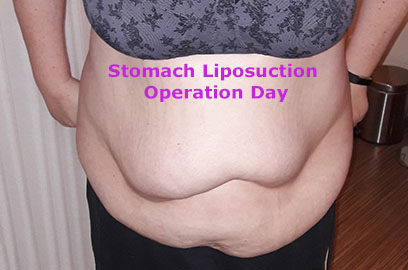 Stomach Liposuction for Lipedema Surgery Day