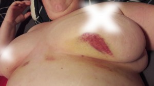 Wicked under boob bruise from stomach liposuction