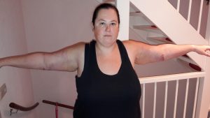 2nd day after arm liposuction