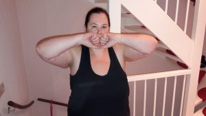 Arm Liposuction Day 2 Post Op