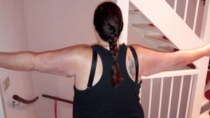 Back of arms 2nd day post op