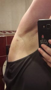 Pre-surgery after a sports massage