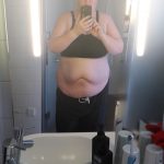 Before Surgery 7 - front
