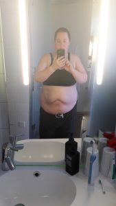 Before Surgery 7 - front
