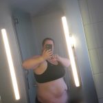 Before 7th Liposuction - left side