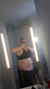 Before 7th Liposuction - left side