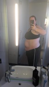 Before 7th liposuction - right side