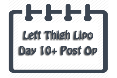 Left Thigh Liposuction: Days 10-21 Post Op