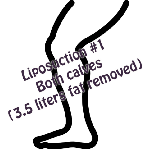 calf-liposuction-001 Liposuction #1 - Calf Liposuction