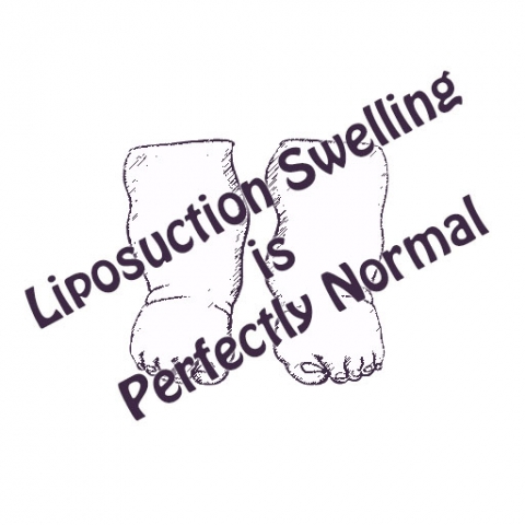 liposuction-swelling Liposuction Swelling is Normal