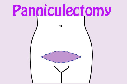 8th Liposuction for Lipedema and a Panniculectomy
